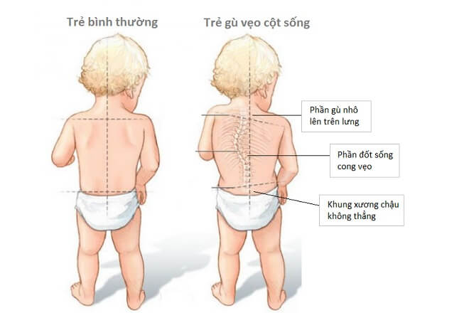 Trẻ bị gù lưng