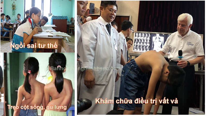 Căn bệnh gù lưng, chẹo cột sống ở trẻ em Căn bệnh gù lưng, chẹo cột sống ở trẻ em