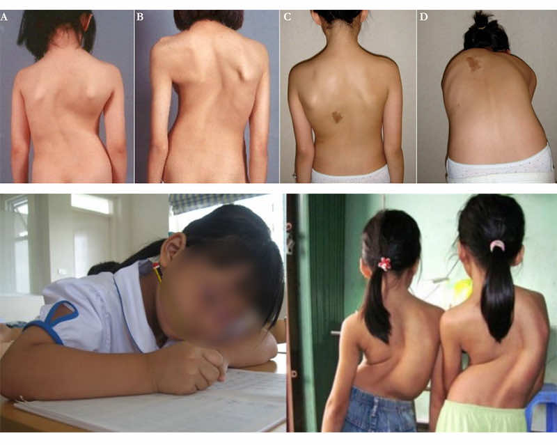 Thực trạng trẻ em mắc những căn bệnh học đường tại Việt Nam
